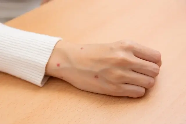 これ本当にゴキブリ？他の虫刺されとの見分け方